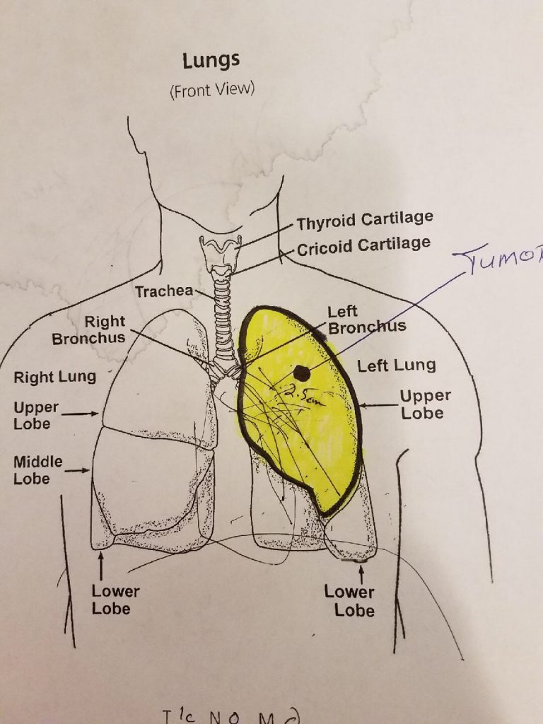 Adenocarcinoma